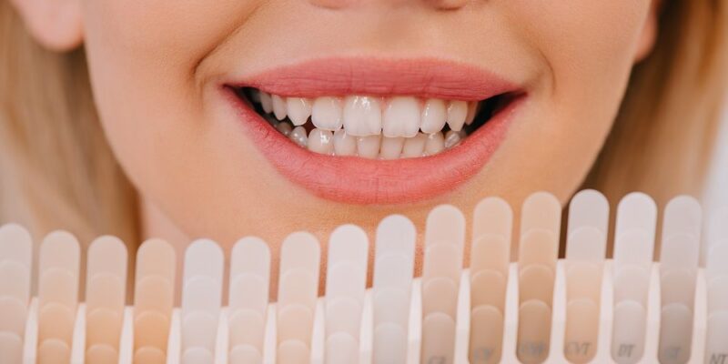 Wybielanie zębów – szybki sposób na olśniewający uśmiech